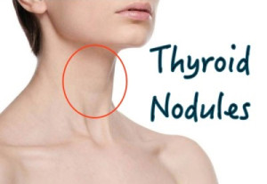 what is a thyroid nodule